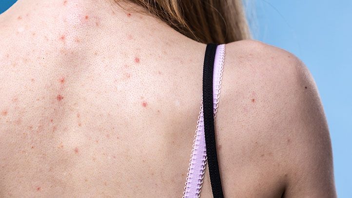 Treat Back Acne with a Back Facial