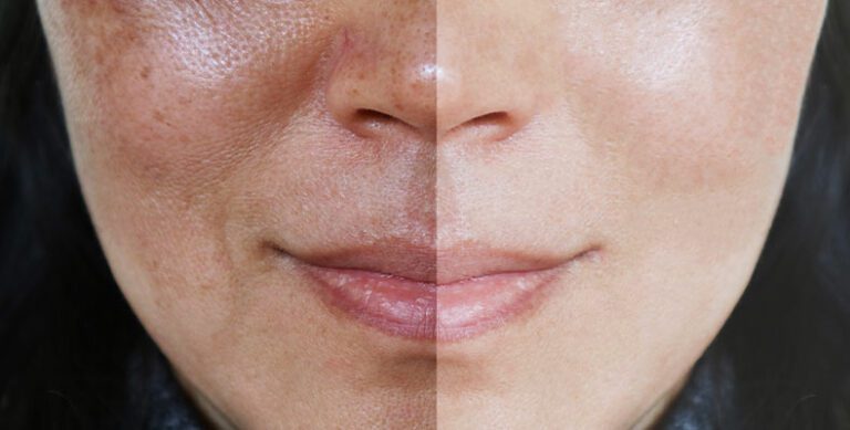 Hyperpigmentation Products And Services That Work