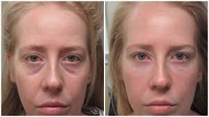 Tear Troughs are tied to cheek volume