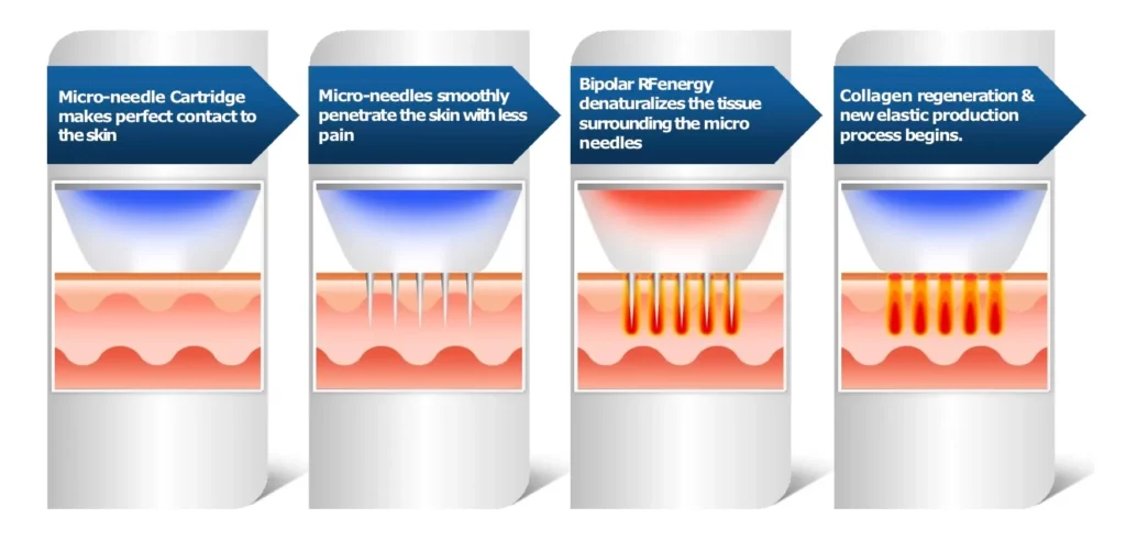 Infographic of how Pixel8-RF Microneedling works