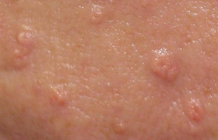Understanding and Treating Sebaceous Hyperplasia